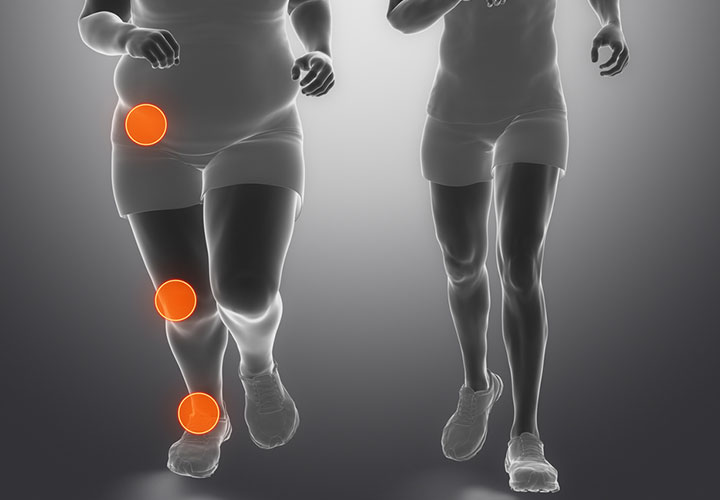 تأثير السمنة على المفاصل - كيف يؤثر الوزن على صحتك الحركية؟