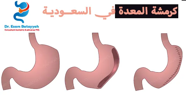 أفضل عيادة لعمل كرمشة المعدة في السعودية
