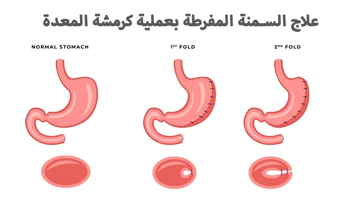 علاج السمنة المفرطة بعملية كرمشة المعدة