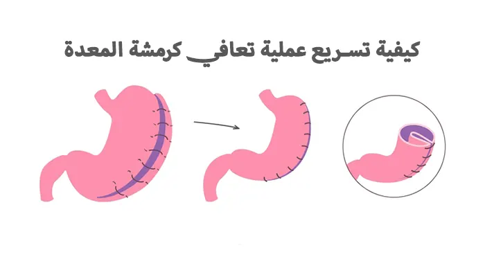كيفية تسريع عملية التعافي من عملية كرمشة المعدة