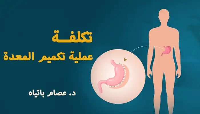 تكلفة عملية تكميم المعدة: تفاصيل كاملة من خبير سمنة