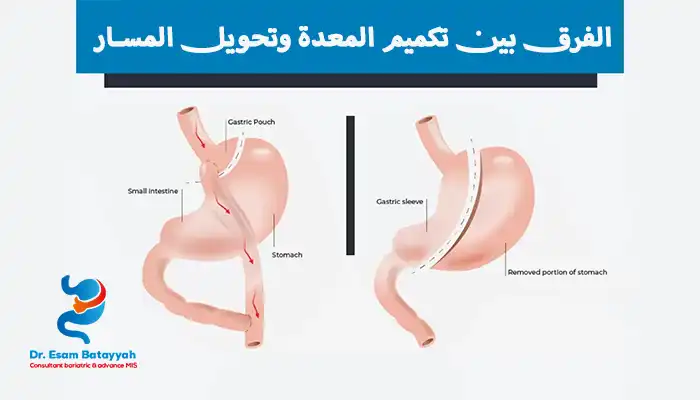 الفرق بين تكميم المعدة وتحويل المسار