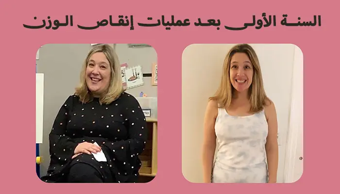 السنة الأولى بعد عمليات إنقاص الوزن!