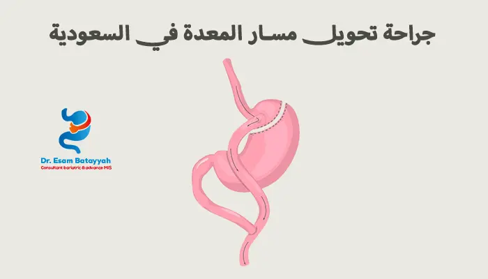 جراحة تحويل مسار المعدة في السعودية - دليل شامل