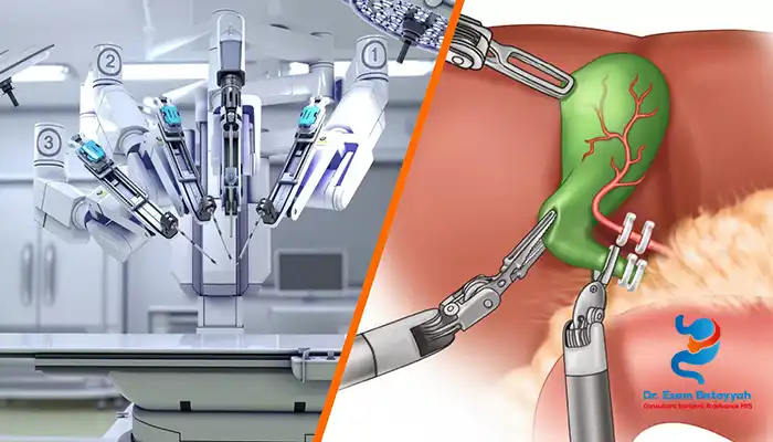 استئصال المرارة بالروبوت