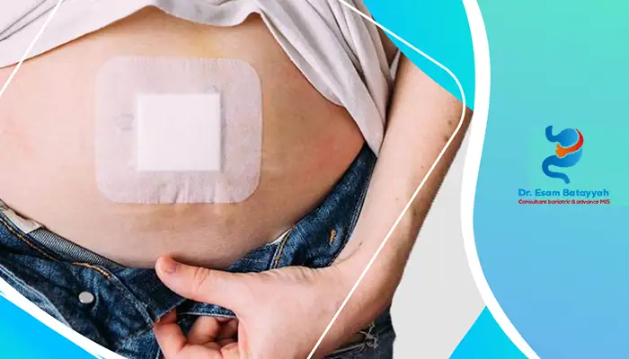 ما هي عملية إصلاح الفتق في جدار البطن؟