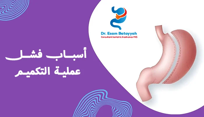 أسباب فشل عملية التكميم