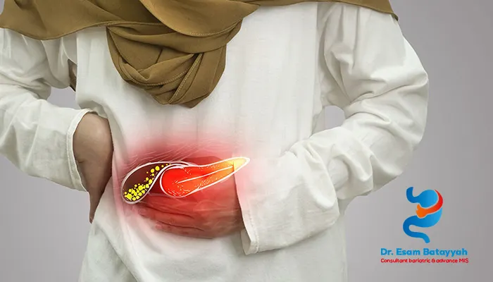 أعراض حصوات المرارة مع التشخيص والعلاج