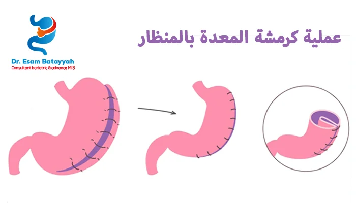 عملية كرمشة المعدة بالمنظار