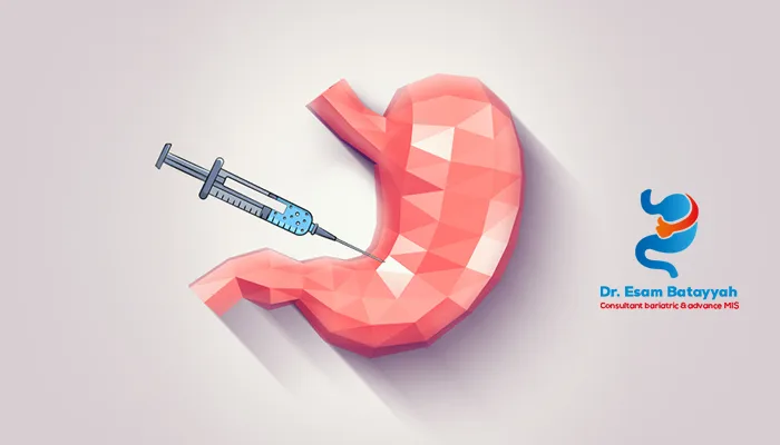 ما هي عملية بوتوكس المعدة؟