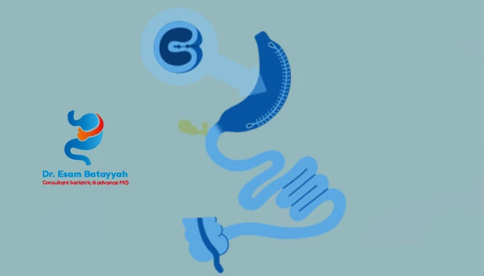 نسبة نجاح كرمشة المعدة