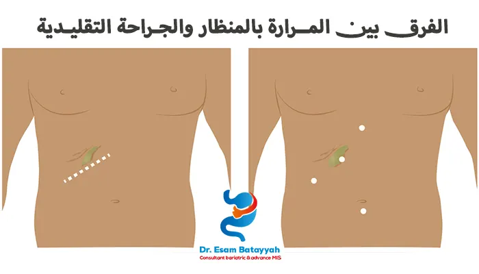 الفرق بين المرارة بالمنظار والجراحة التقليدية