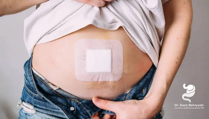 علاج فتق السرة متى تكون الجراحة ضرورية؟