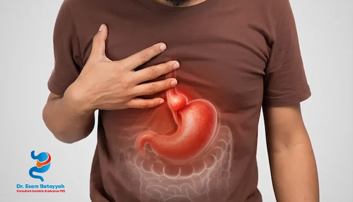 أعراض فتق الحجاب الحاجز التي لا يجب تجاهلها