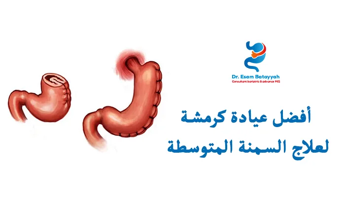 أفضل عيادة كرمشة لعلاج السمنة المتوسطة