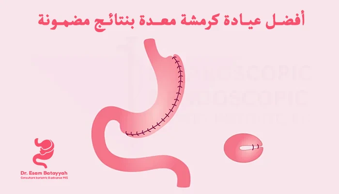 أفضل عيادة كرمشة معدة بنتائج مضمونة