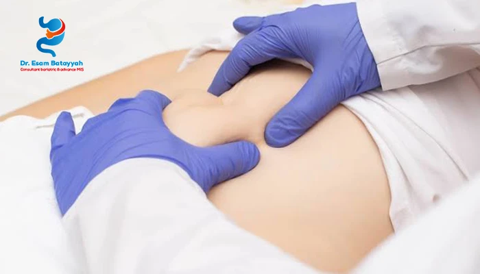 أفضل وأحدث طريقة لعلاج فتق السرة عند الكبار