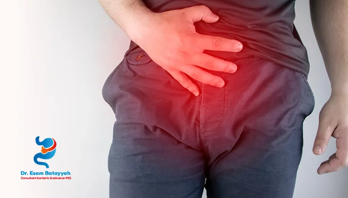 الفتق الإربي عند الرجال: الأعراض والعلاج