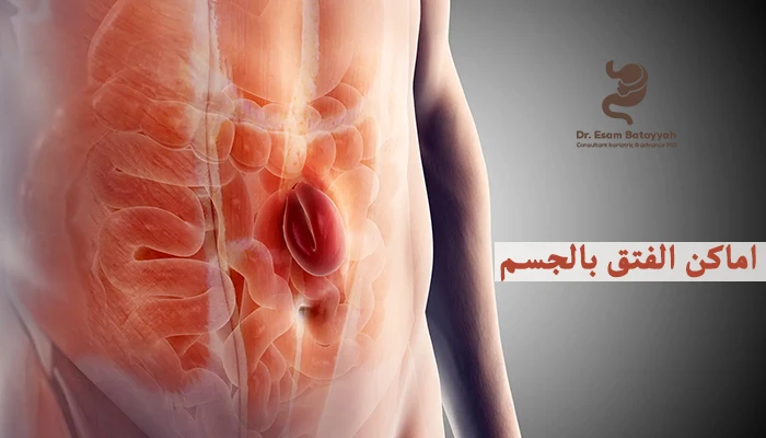 اماكن الفتق بالجسم وما أشهر أنواعه وأعراضه؟