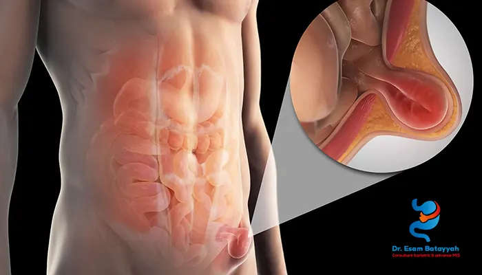 علاج الفتق بدون تأخير: متى تحتاج إلى الجراحة؟