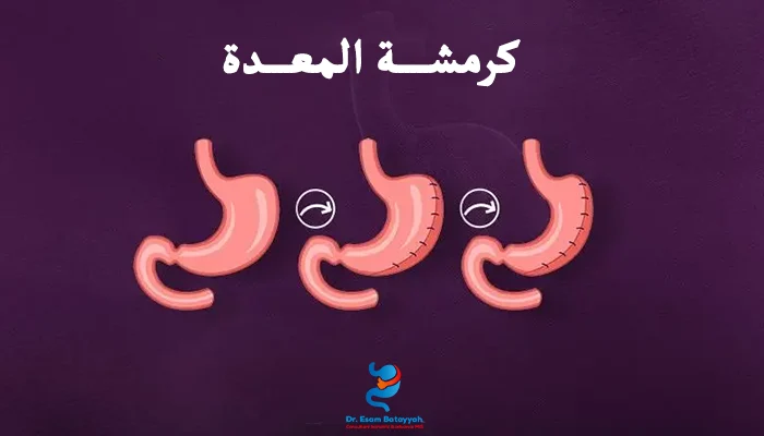 كيف تتم عملية كرمشة المعدة خطوة بخطوة؟